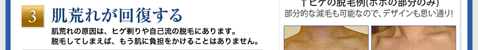 「肌荒れが回復する」肌荒れの原因は、ヒゲ剃りや自己流の脱毛にあります。脱毛してしまえば、もう肌に負担をかけることはありません。